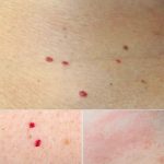 Red Spots on Skin: 13 Common Causes