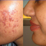 The 3 Lessons Having Severe Cystic Acne In my 20s Taught Me