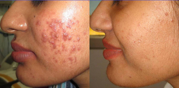 The 3 Lessons Having Severe Cystic Acne In my 20s Taught Me