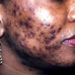 Cystic acne made me feel ugly