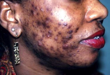 Cystic acne made me feel ugly