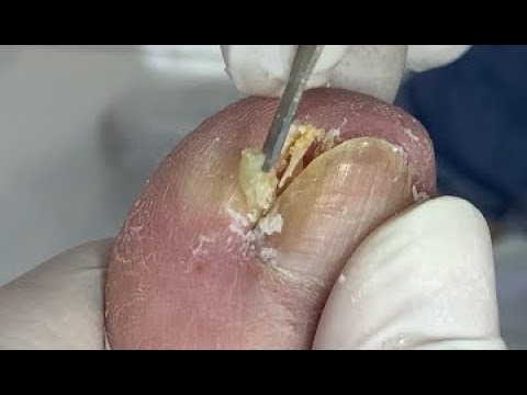 How to repair nails