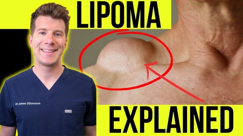 “Understanding Cyst & Lipoma Removal: A Step-by-Step Guide to Safe and Effective Procedures”