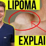 “Understanding Cyst & Lipoma Removal: A Step-by-Step Guide to Safe and Effective Procedures”