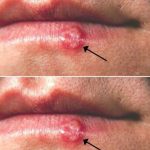 Most People Have Had or Have This Cold Sore Virus, But Very Few Know How to Cure It – Here’s What You Need to Do!