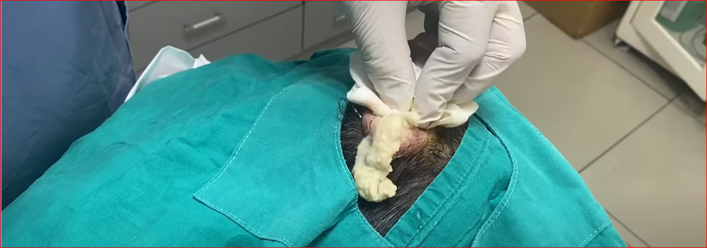 Sebaceous Cysts: Causes, Treatment Options, and When to See a Doctor