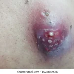 Complete Guide to Treating Big Cystic Acne and Blackheads: Causes, Treatments, and Expert Advice