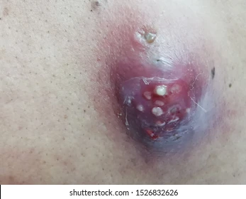 Complete Guide to Treating Big Cystic Acne and Blackheads: Causes, Treatments, and Expert Advice