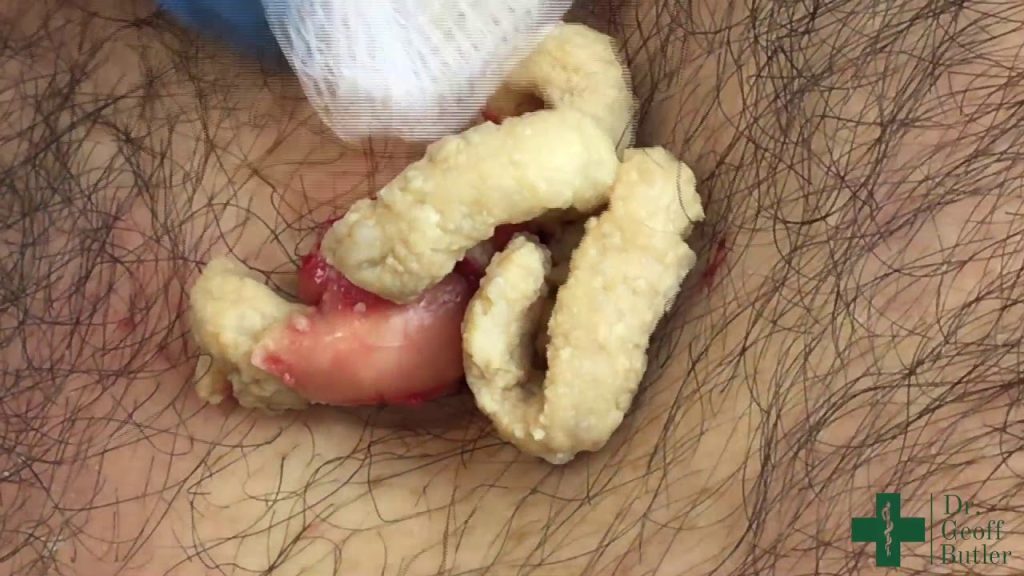 Successful Removal of a Large Epidermal Cyst from the Mid-Chest: A Comprehensive Procedure Overview