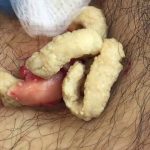 Successful Removal of a Large Epidermal Cyst from the Mid-Chest: A Comprehensive Procedure Overview