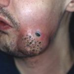 Everything You Need to Know About Whiteheads