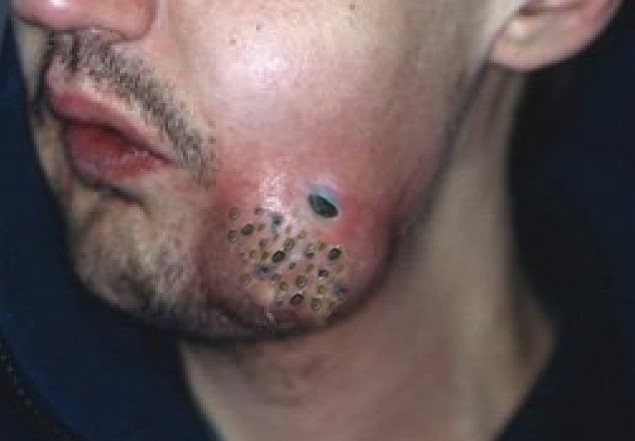 Everything You Need to Know About Whiteheads