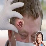 “How to Safely Treat and Remove Giant Blackheads (Dilated Pores of Winer): A Dermatologist-Backed Guide”