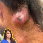 Dr. Blackhead Extractions EP:560 REMOVAL PIMPLE