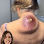 “Comprehensive Guide to the Safe Removal of Large Skin Cysts”