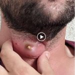 “Varicella-Related Abscesses: Diagnosis, Treatment, and Prevention Strategies”