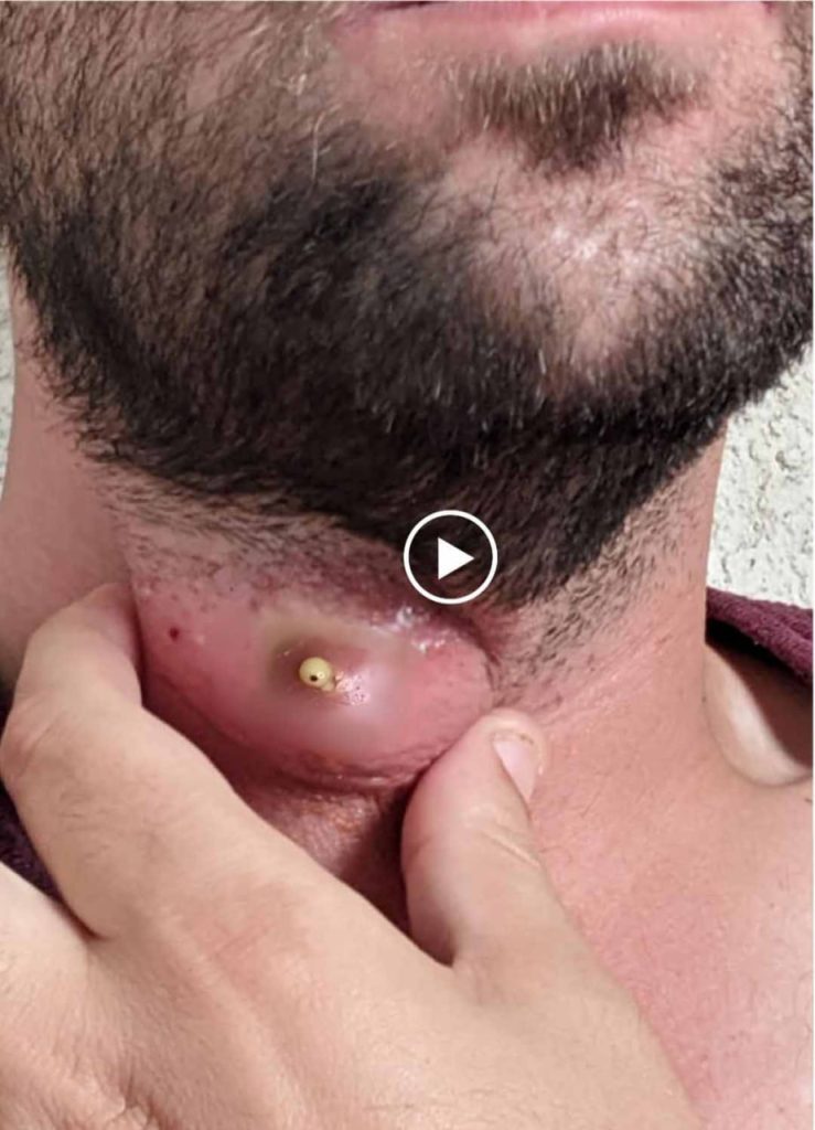 “Varicella-Related Abscesses: Diagnosis, Treatment, and Prevention Strategies”