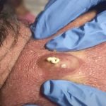 Treatment Options for Small Lumps and Cysts: A Complete Guide
