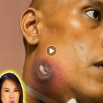 Everything You Want to Know About Acne