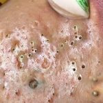 “The Ultimate Guide to Getting Rid of Blackheads: Dermatologist-Backed Skincare Tips”