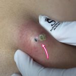 How do I get rid of blackheads safely