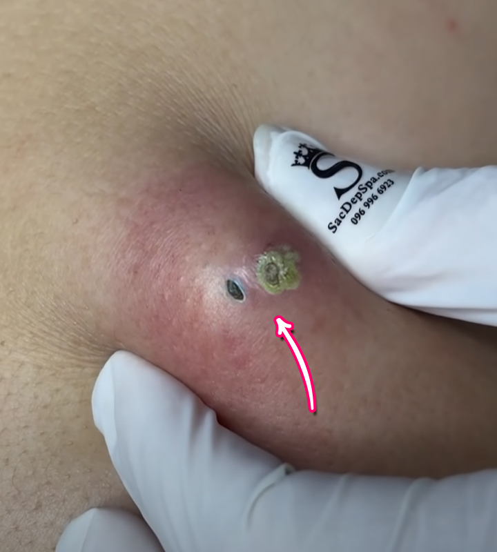 How do I get rid of blackheads safely