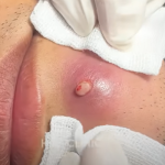 WHAT CAUSES THIS ACNE..