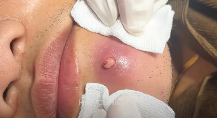 WHAT CAUSES THIS ACNE..