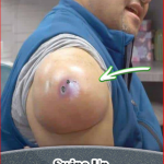 Largest Lipoma Removals (Full video)