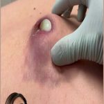 Dr. Blackhead Extractions EP:578 REMOVAL PIMPLE