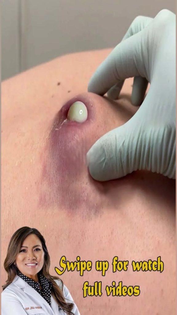 Dr. Blackhead Extractions EP:578 REMOVAL PIMPLE