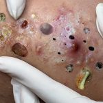 How to Safely Remove a Giant Blackhead: Step-by-Step Treatments, Tools & Product Guide
