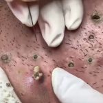 The Most Satisfying Blackhead Extractions: Deep Pore Cleansing for Clearer Skin