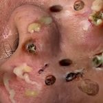 Blackheads Removal | Acne treatment and very satisfying satisfying pimple popping