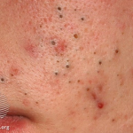 Understanding Whiteheads: Causes, Types, and Treatment Options