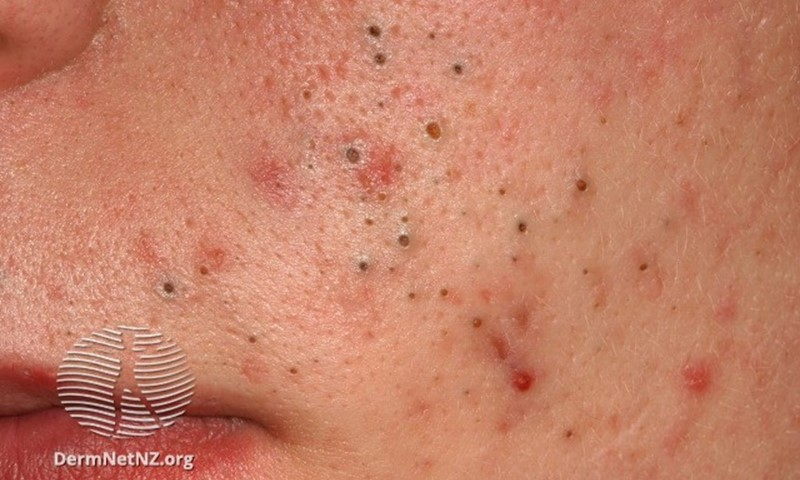 Understanding Whiteheads: Causes, Types, and Treatment Options