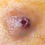 “Sebaceous Cyst Treatment Explained: From Home Care to Surgery”
