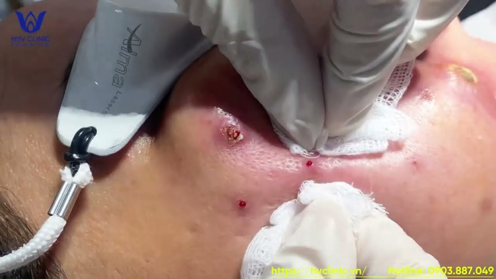 When Skincare Gets Messy: The Shocking Cyst Explosion That Surprised Even the Doctor”