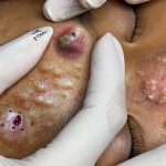 “Effective Treatments for Cystic Acne and Blackheads: A Step-by-Step Guide with Research-Backed Solutions”