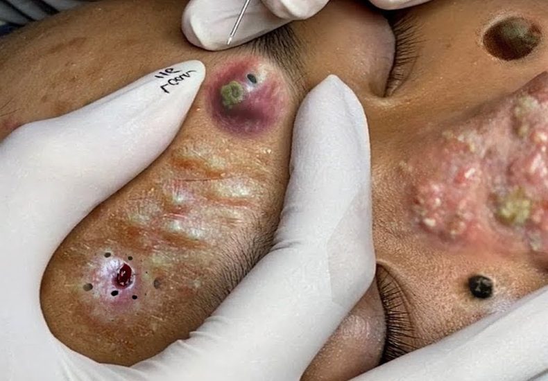 “Effective Treatments for Cystic Acne and Blackheads: A Step-by-Step Guide with Research-Backed Solutions”