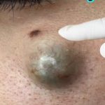 Comprehensive Management of Large Abscesses: Assessment, Treatment, and Aftercare
