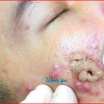 “How to Safely Treat Blackheads and Previously Inflamed Cysts: A Dermatologist-Backed Guide”