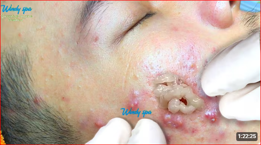 “How to Safely Treat Blackheads and Previously Inflamed Cysts: A Dermatologist-Backed Guide”