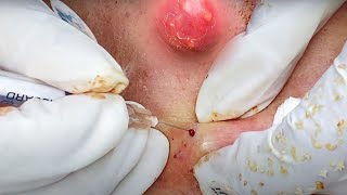 “Cystic Acne and Blackheads: Causes, Treatments, and Evidence-Based Care”
