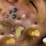 “Comprehensive Guide to Treating Acne, Pimples, and Blackheads: Causes, Treatments, and Expert-Backed Solutions”