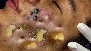 “Comprehensive Guide to Treating Acne, Pimples, and Blackheads: Causes, Treatments, and Expert-Backed Solutions”