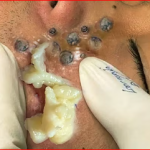 “How to Treat and Prevent Big Pimples: Solutions for Clear Skin”( Full Video)
