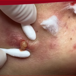 📘 Comprehensive Guide to Acne Treatment: Evidence-Based Options for Clearer Skin