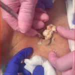 Large Cyst Squirts and Oozes from Patient’s Neck