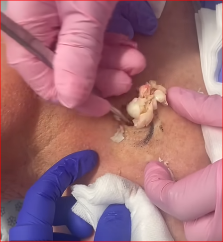 Large Cyst Squirts and Oozes from Patient’s Neck